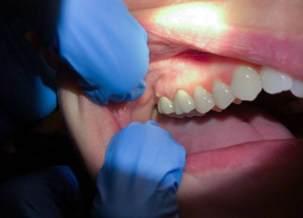 Best Knocked-Out Tooth Emergency  in Dawson Springs, KY